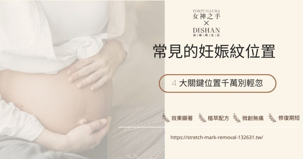 妊娠紋位置 